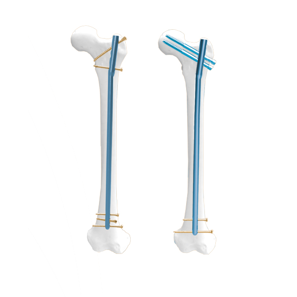 Cannulated Cyrus Femur Nail
